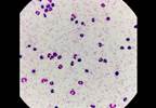 Tafenoquine Appears Safe and Effective for Prevention of Malaria Tafenoquine Appears Safe and Effective for Prevention of Malaria