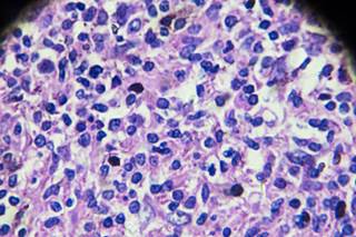 None of the patients experienced HBV reactivation or treatment-related side effects with lamivudine. None of the patients experienced HBV reactivation or treatment-related side effects with lamivudine.