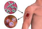 Topical 15% Paromomycin-Aquaphilic Effective For New World Leishmaniasis Topical 15% Paromomycin-Aquaphilic Effective For New World Leishmaniasis