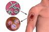 Topical 15% Paromomycin-Aquaphilic Effective For New World Leishmaniasis Topical 15% Paromomycin-Aquaphilic Effective For New World Leishmaniasis