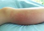 ASSET Score Provides Reliable Indication for IV Antibiotics in Children With Cellulitis ASSET Score Provides Reliable Indication for IV Antibiotics in Children With Cellulitis