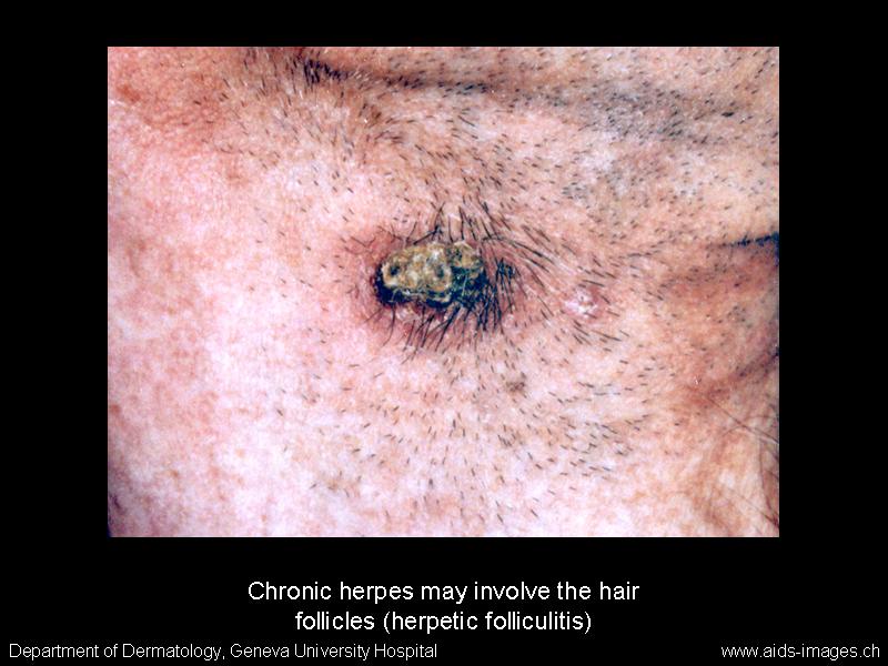 herpes simplex virus treatment